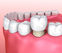 Dental Crowns Livingston Montana Dental Services