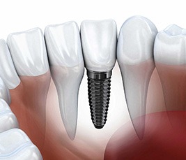 Dental Implants Livingston Montana Dental Services