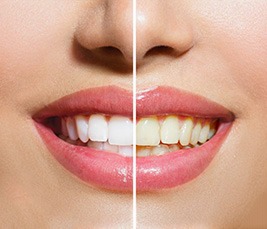 Teeth Whitening Livingston Montana Dental Services